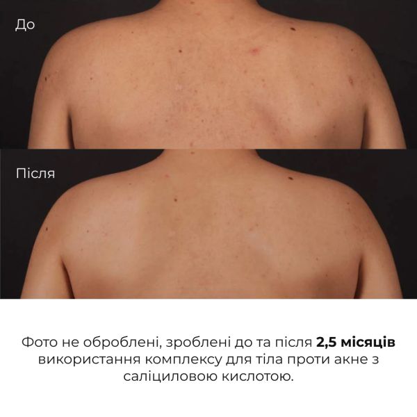 Комплекс против высыпаний на теле и глубокого питания Hillary Body Acne & Deep Nourishment Complex