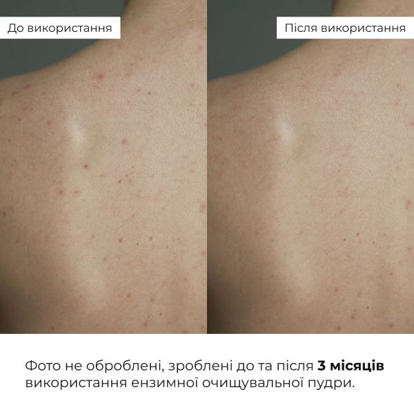 Набор против жирности и высыпаний Hillary Anti-Oil & Breakouts Set