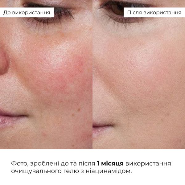 Набор против жирности и высыпаний Hillary Anti-Oil & Breakouts Set