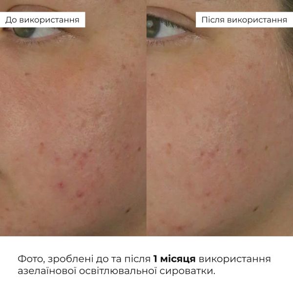 Комплекс для сухого типа кожи с азелаиновой кислотой Hillary Skincare Set for Dry Skin with Azelaic Acid