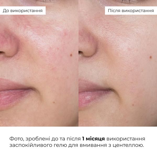 Набор для чувствительной и сухой кожи с центеллой и пробиотиками Hillary Centella & Probiotic