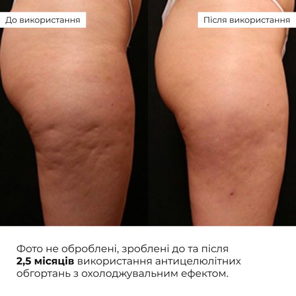 Набор антицеллюлитных охлаждающих обертываний Hillary Cooling Anti-Cellulite Wrap Set