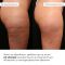 Набор антицеллюлитных охлаждающих обертываний Hillary Cooling Anti-Cellulite Wrap Set