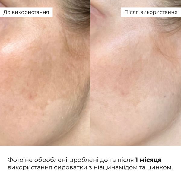 Набор против жирности и высыпаний Hillary Anti-Oil & Breakouts Set