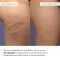 Набор антицеллюлитных охлаждающих обертываний Hillary Cooling Anti-Cellulite Wrap Set