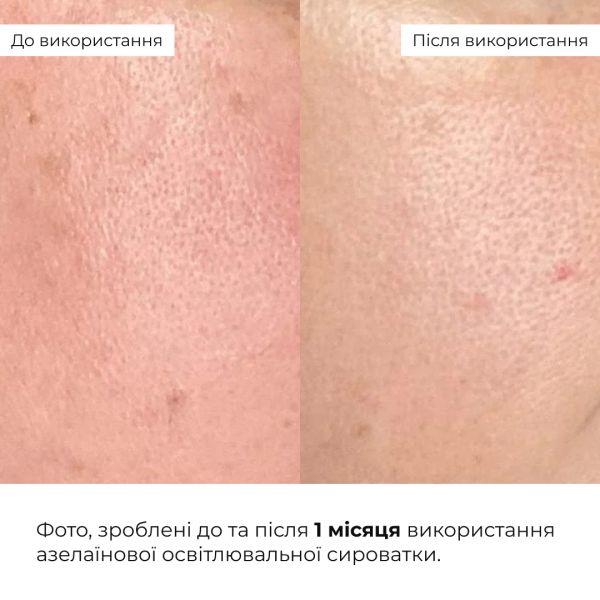 Набор для увлажнения и осветления тона кожи лица с азелаиновой кислотой Hillary Hydration & Azelaic Brightening Set