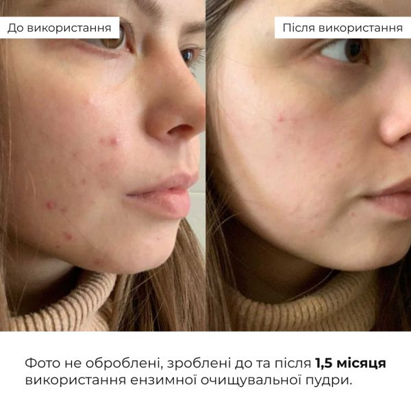 Набор для глубокой очистки и себоконтроля кожи Hillary Deep Cleansing & Sebum Control Set