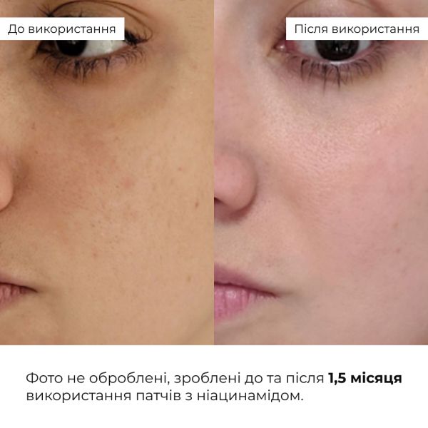 Мультифункціональні патчі з ніацинамідом Hillary Niacinamide Multi Eye Patches, 60 шт