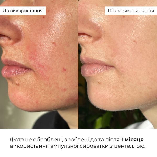 Набор для восстановления и осветления чувствительной кожи Hillary Sensitive Skin Recovery & Glow Set