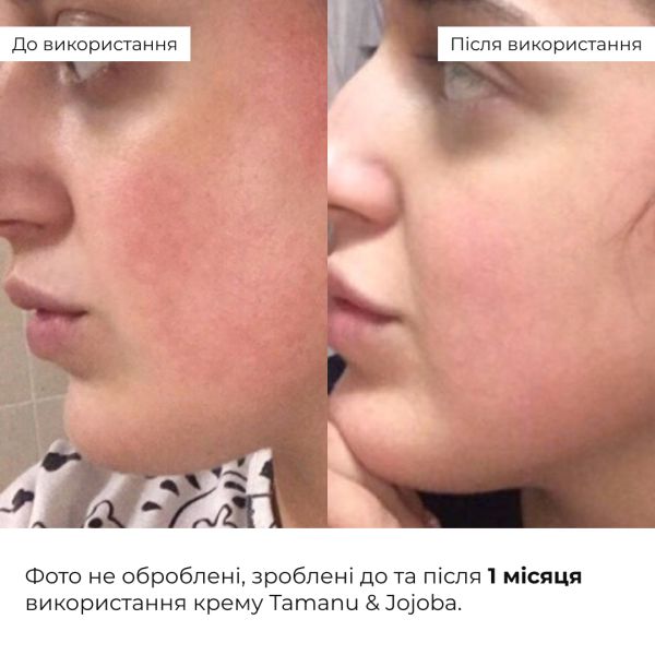 Набор себорегулирующего ухода для жирной и проблемной кожи лица Hillary for oily and problematic skin