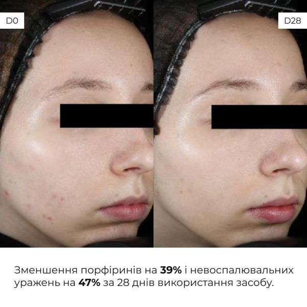 Набор себорегулирующего ухода для жирной и проблемной кожи лица Hillary for oily and problematic skin