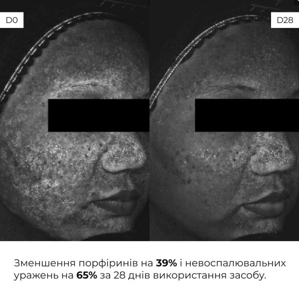 Набор себорегулирующего ухода для жирной и проблемной кожи лица Hillary for oily and problematic skin