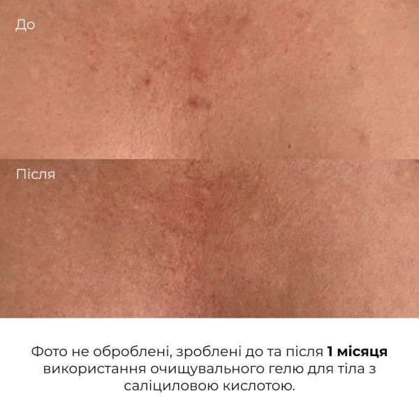 Очищувальний гель для тіла з саліциловою кислотою Hillary Anti-Acne Salicylic Body Wash, 200 мл