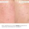 Набор против тусклости, постакне и пигментации Hillary Anti-Dullness & Post-Acne Brightening Set